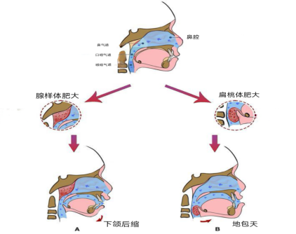 0129 孩子睡觉老张嘴，为啥？537.png